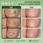 Naily - מארז לטיפול פטרת ציפוניים